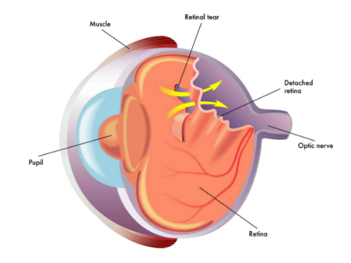 distacco retina resized