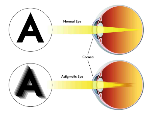 astigmatismo resized