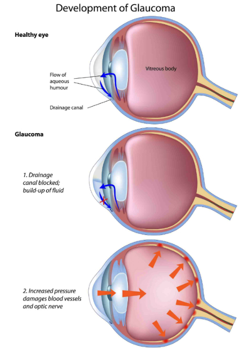 glaucoma resized